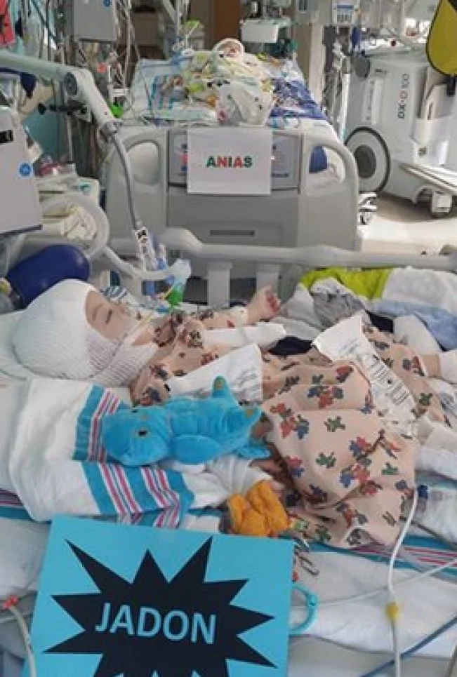Conjoined twins, who shared one head, are successfully separated! Both toddlers survived! PHOTOS Conjoined twins, who shared one head, are successfully separated! Both toddlers survived! PHOTOS