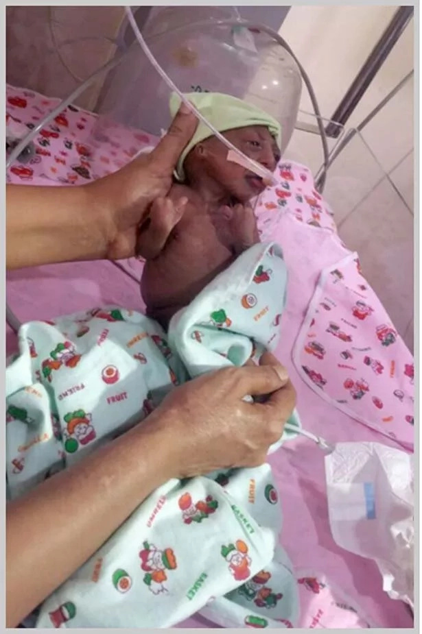 Bebé de dos semanas de nacida fue abandona por sus padres porque nació “fea” con un una debilitante enfermedad
