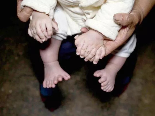 Look at the excess toes and fingers this baby has! Look at the excess toes and fingers this baby has!