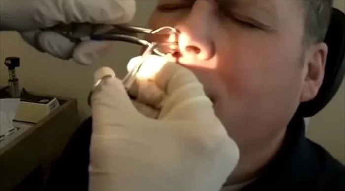 WATCH: Doctor pulls monster booger from man’s nose; you won’t believe how big it is! WATCH: Doctor pulls monster booger from man’s nose; you won’t believe how big it is!