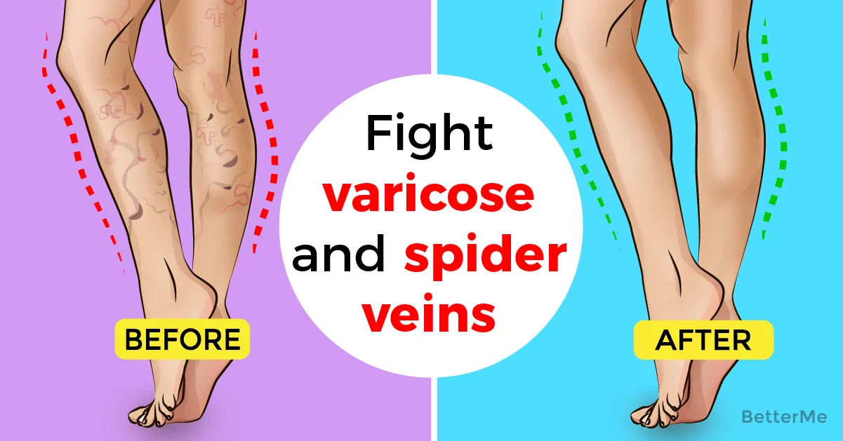 10 effective ways to fight varicose and spider veins