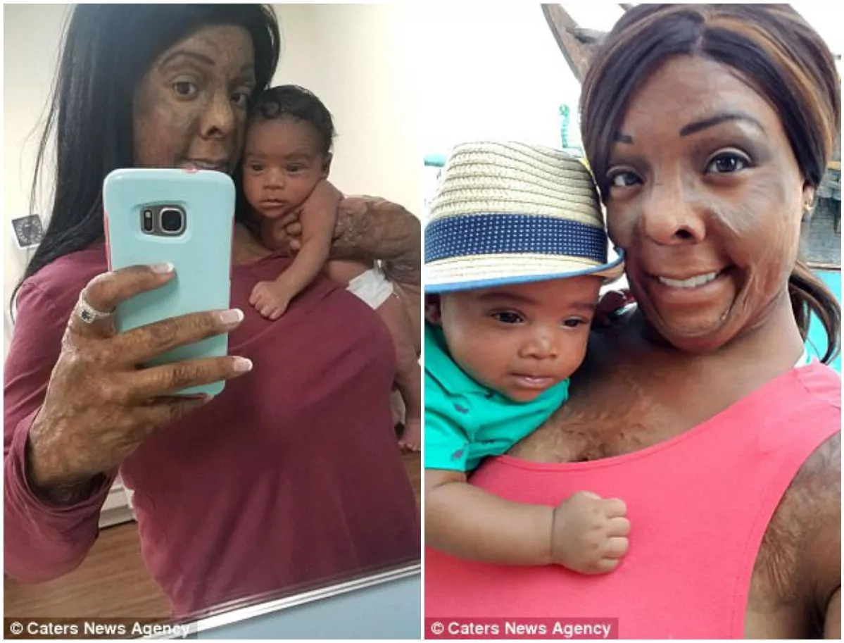 Mom, 34, who suffered severe burns at age of 2 is finally able to breastfeed her baby Mom, 34, who suffered severe burns at age of 2 is finally able to breastfeed her baby