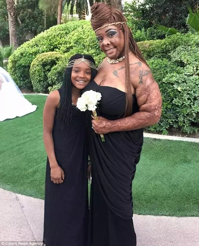 Mom, 34, who suffered severe burns at age of 2 is finally able to breastfeed her baby Mom, 34, who suffered severe burns at age of 2 is finally able to breastfeed her baby