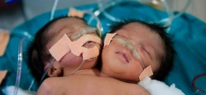 She expected one baby, but instead got two girls in one body, but with two heads! PHOTOS