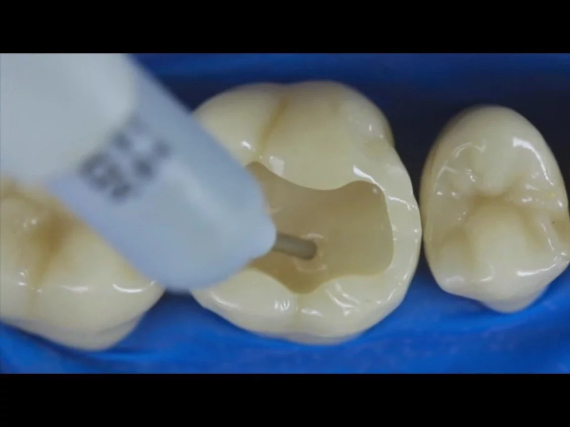 First the tooth is filled with a special plaster First the tooth is filled with a special plaster