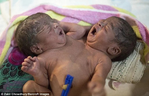 Conjoined Twins Born With Two Heads, Four Hands And Two Legs & Dumped By Parents (Photos) Conjoined Twins Born With Two Heads, Four Hands And Two Legs & Dumped By Parents (Photos)