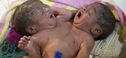 Conjoined Twins Born With Two Heads, Four Hands And Two Legs & Dumped By Parents (Photos)
