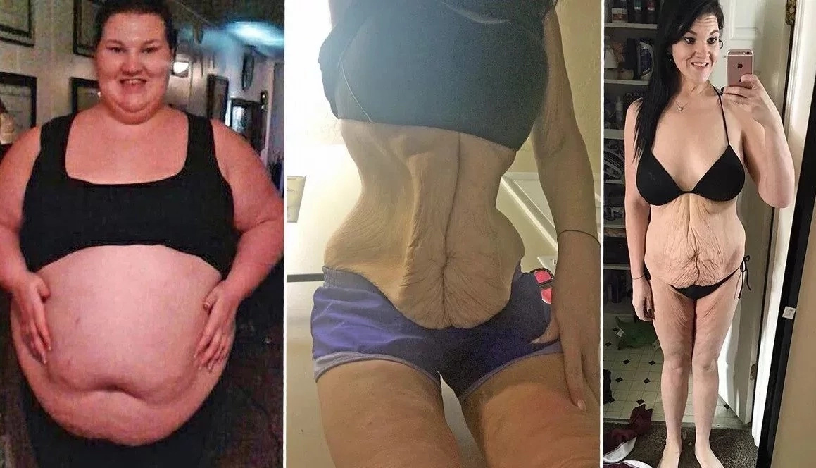 Woman who weighed 188 kg sheds HALF her weight but has to live with bags of floppy skin (photos)