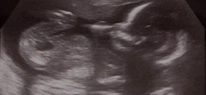 Woman lost her child but is still pregnant 2 weeks later