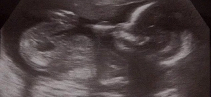 Woman lost her child but is still pregnant 2 weeks later