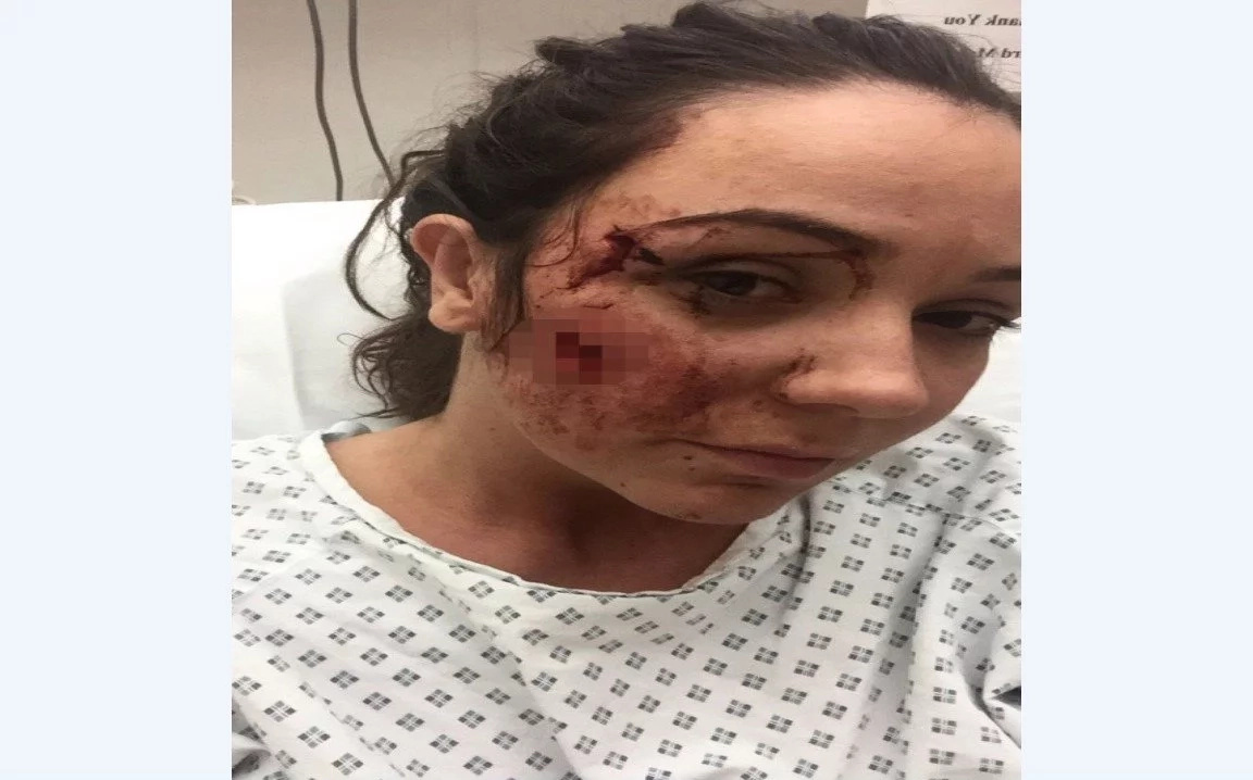 Woman, 25, left with permanent scars and facial twitches after female thug glassed her for smiling at her in a bar Woman, 25, left with permanent scars and facial twitches after female thug glassed her for smiling at her in a bar