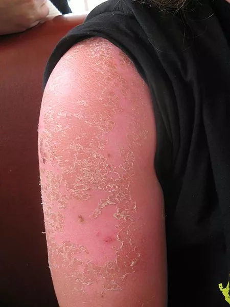 Watch out for this six summer diseases Watch out for this six summer diseases