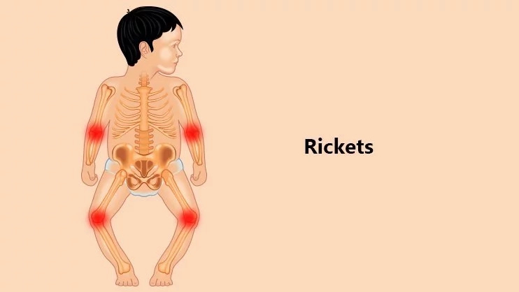 Causes And Symptoms Of Rickets