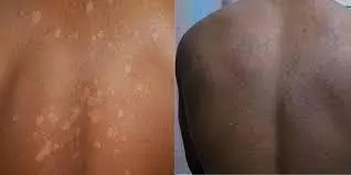 Eczema in Nigeria: Causes, Signs and Treatments