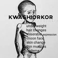 Causes and Symptoms of Kwashiorkor