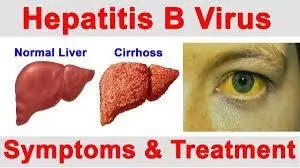 Causes and Cure for Hepatitis B
