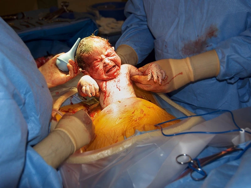 Preoperative Preparation for Cesarean Section