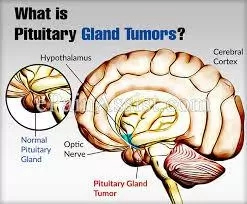 Advanced Treatments For Pituitary Gland Tumors In India