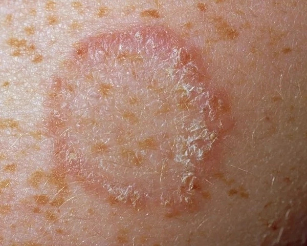 Ringworm in Nigeria: Causes, Symptoms and Treatments