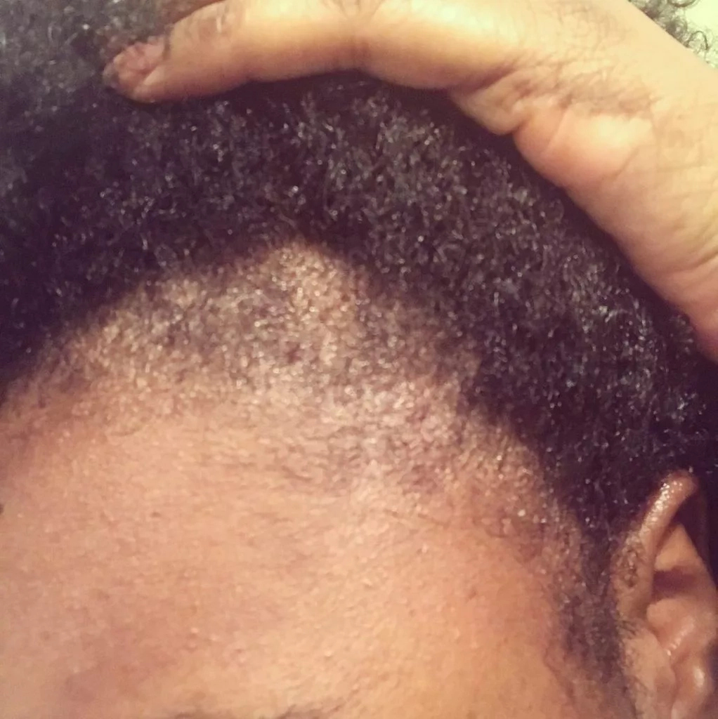 How to Stop Hair Breakage in Nigeria