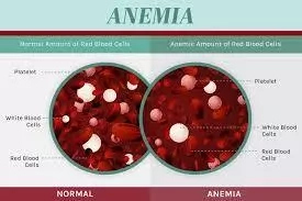 Anemia Treatment Foods
