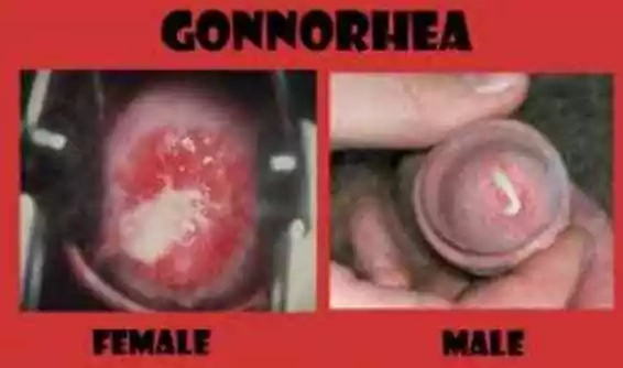 Gonorrhea: Causes, Symptoms and Treatments