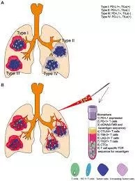 Immunotherapy for Lung Cancer: What You Need to Know