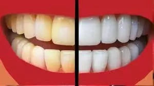 How To Whiten Your Teeth Using Home-Made Materials