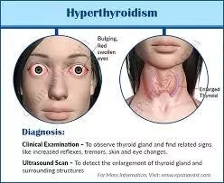 Helpful Guide To Treat Hyperthyroidism
