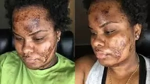 9 Harmful Effects Of Skin Bleaching Creams To Your Health