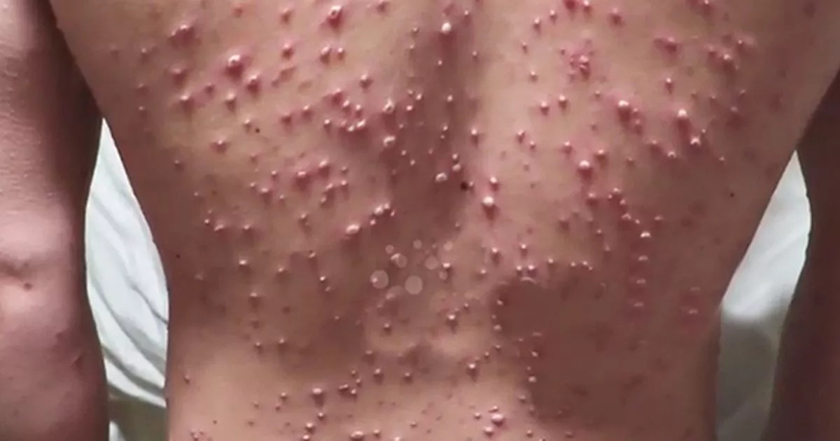 Chickenpox: Prevention and Treatments 