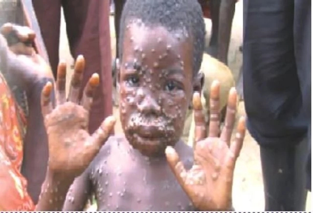 Polio Virus In Nigeria; Causes, Symptoms, Treatments
