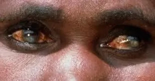 9 Causes of Blindness In Nigeria