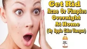 How to Get Rid of Acne Medically and Naturally 