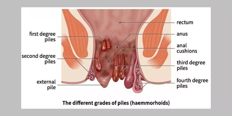 Pile: Causes, Symptoms, Grades and Treatments 