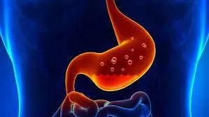 Stomach Ulcer Symptoms and Risk Factors
