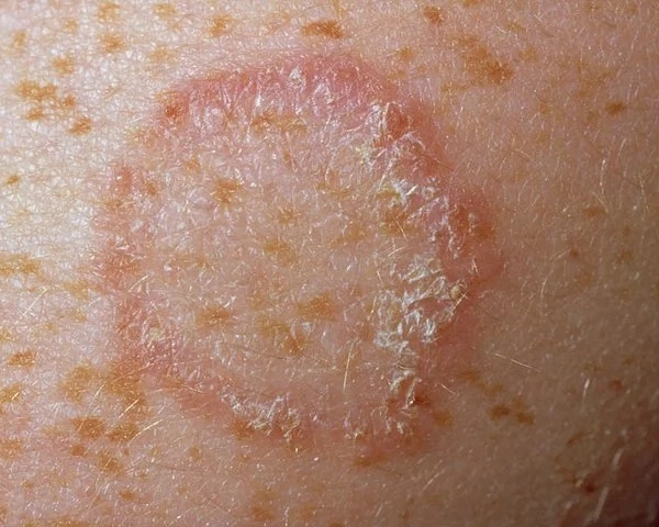Ringworm: Causes, Symptoms and Treatments