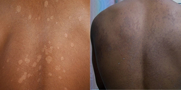Eczema in Nigeria: Causes, Signs and Treatments