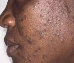 How to Get Rid of Pimples in Nigeria