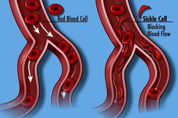 Things to Know About Sickle Cell Anemia