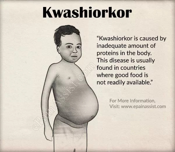 Prevention of Kwashiorkor