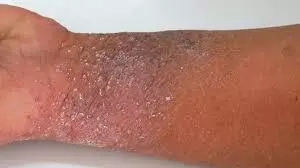 How to Get Rid of Eczema in Nigeria