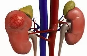 6 Causes of Kidney Diseases in Nigeria