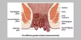 Pile in Nigeria: Causes, Symptoms, Grades and Treatments